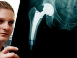 Metal kalça protezleri daha riskli Metal kalça protezleri daha riskli